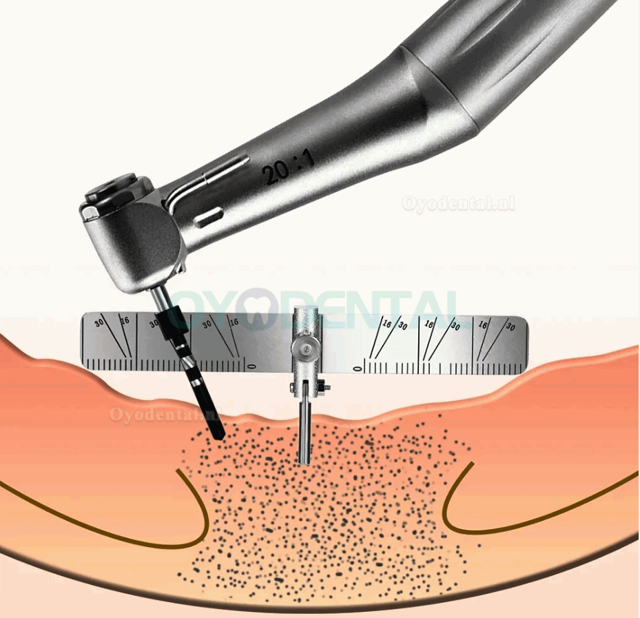 Gids voor het lokaliseren van tandheelkundige implantaten Plaatsbepalingszoeker voor het plaatsen van implantaten