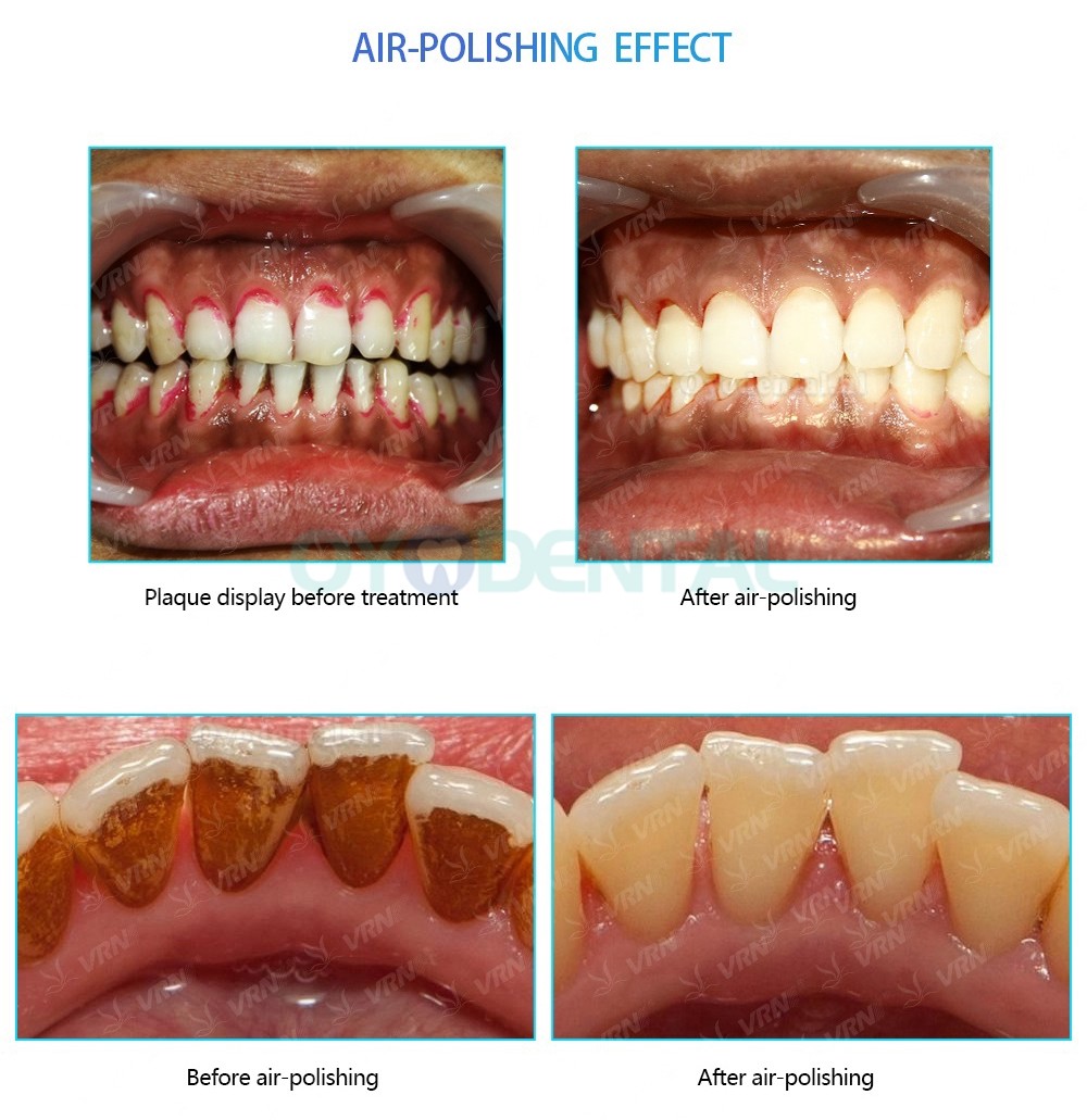 Vrn Q6 Ultrasone Scaler + Luchtpolijstmachine (Scaling Implantaat Parodontale Wortelkanaalbehandeling)