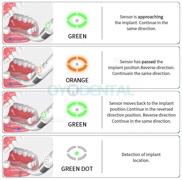 YAHOPE iD1 Tandheelkundige implantaatdetector implantaatlocator slimme 360°roterende sensor